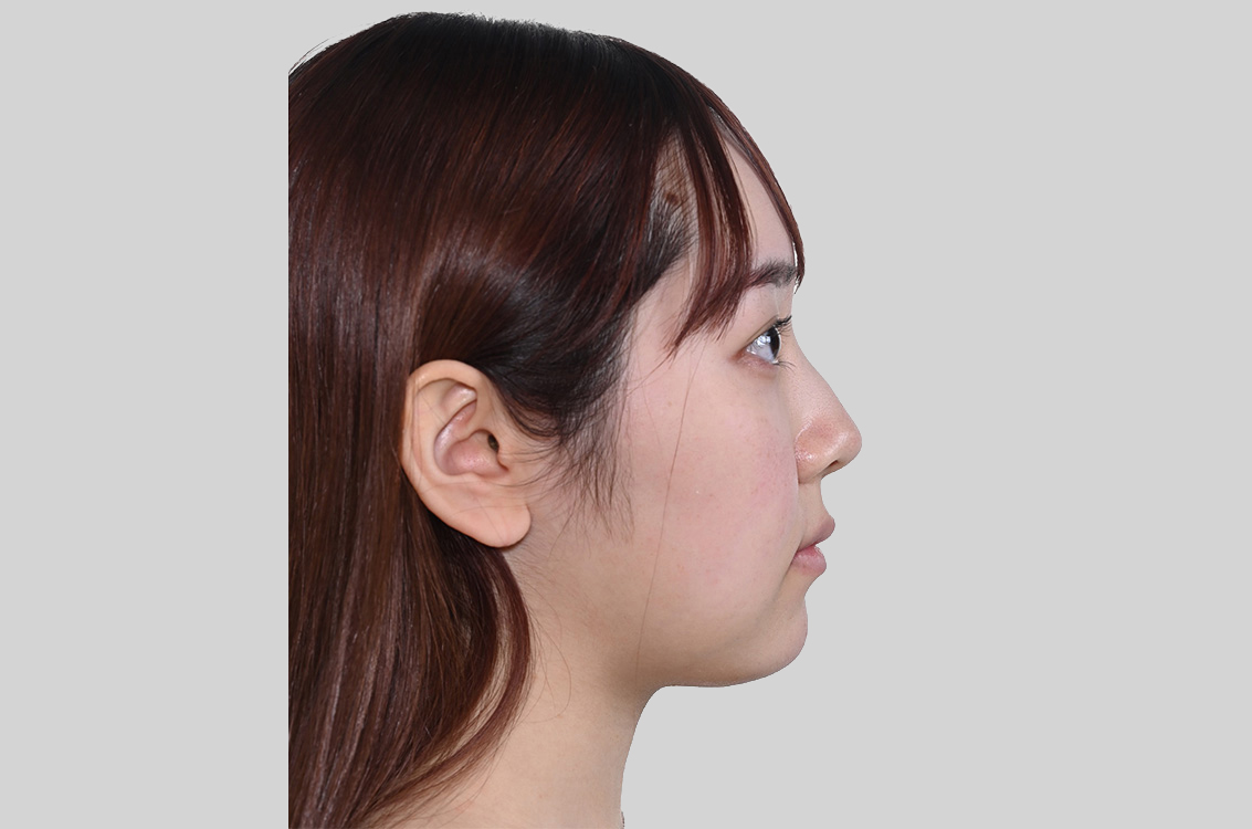 歯のがたつきと出っ歯を治したいの治療後