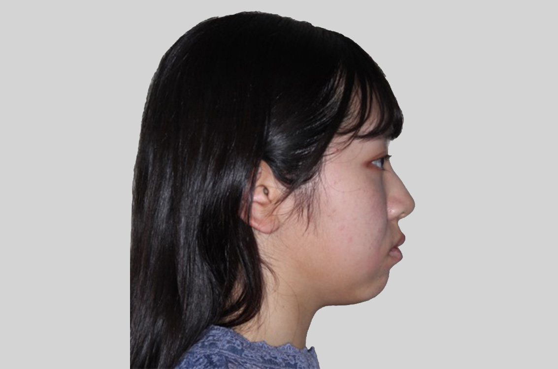 歯のがたつきと出っ歯を治したいの治療前