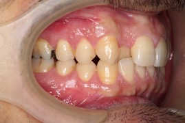 右上の後ろにある前歯が気になるの治療前