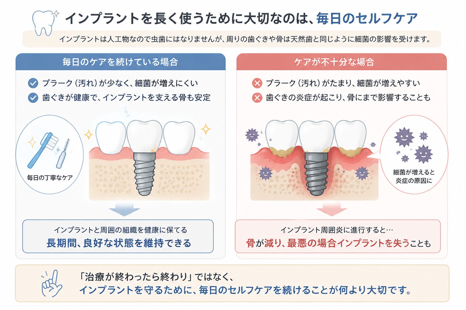 インプラントを長く使うために大切なのは毎日のセルフケア